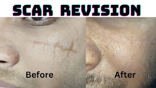 Result of scar revision surgery after 9 months|  Review of scar patient| Big scar on face #scar #dag