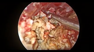 PAINFUL EAR INFECTION - EAR WAX REMOVAL - Dr Paul 2017