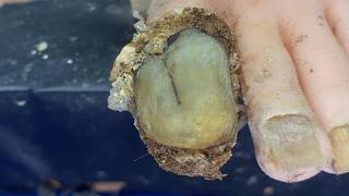 Ingrown toenails with onychomycosis, toenails have fungus black mud 4499