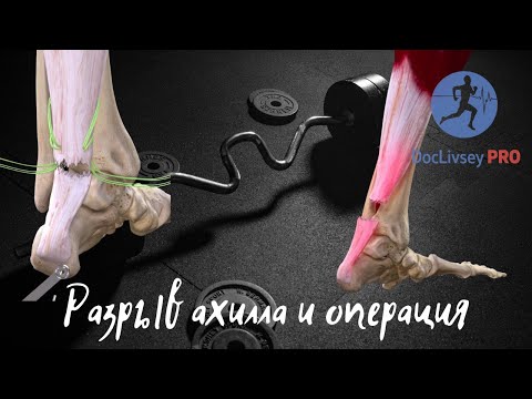 Разрыв ахиллова сухожилия | Операция