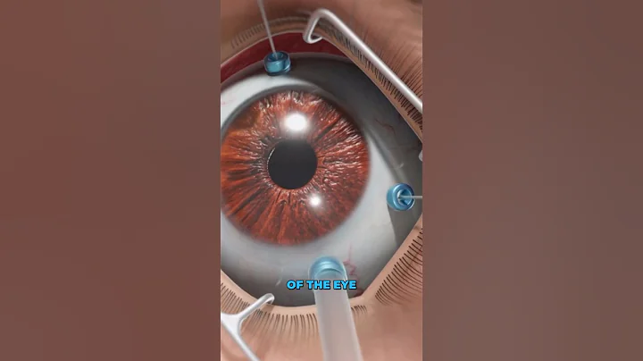 What is a vitrectomy? (3D Animation)