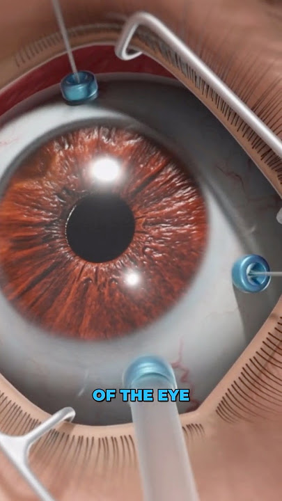 What is a vitrectomy? (3D Animation)