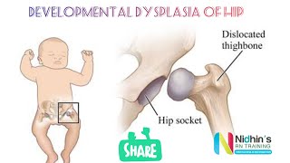 Developmental displasia of Hip ( DDH)