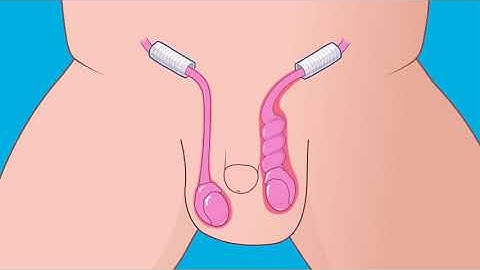 What are Undescended Testicles?