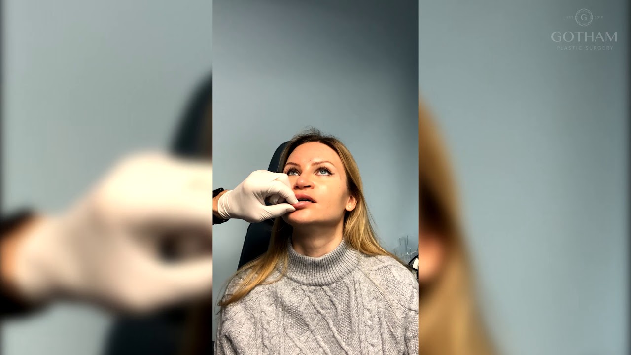 Lip Augmentation Injections for Fuller Looking Lips