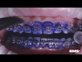 Cleaning Orthodontic Appliances with GBT (Guided Biofilm Therapy)