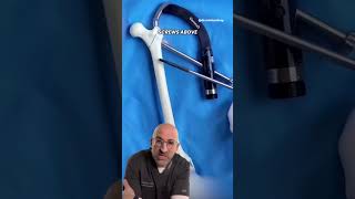 How to Nail a Hip Fracture 🔨 #shorts