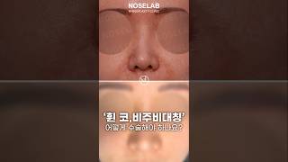 ENG)흔들리던 코, 완전히 바로잡다｜세밀한 코재수술 리얼후기
