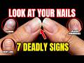 LOOK AT YOUR NAILS RIGHT NOW! 7 Signs of Deadly Disease You Keep Ignoring