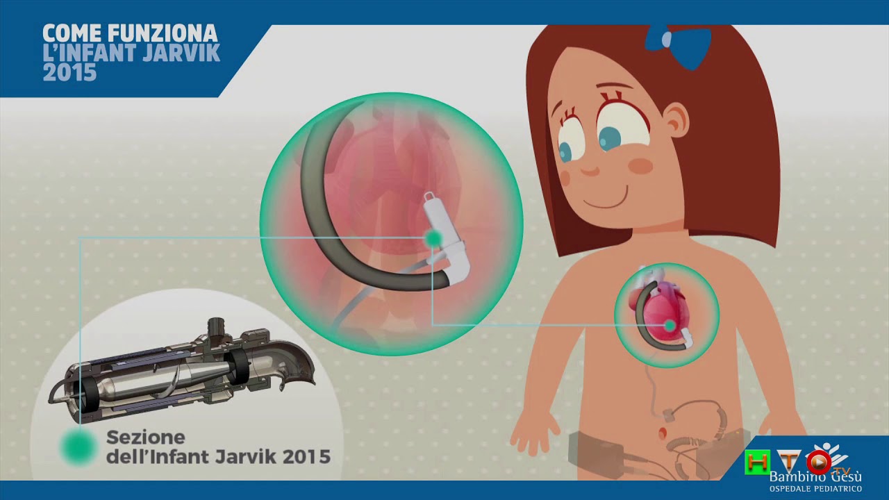 OPBG, Infant Jarvik 2015, Come funziona il mini cuore artificiale - www.HTO.tv