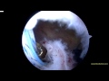 JP L Shoulder arthroscopic C3 rotator cuff repair  050916