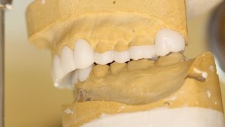 Tips and Tricks: Diagnostic Dental Wax Ups