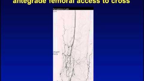 What Is the Ideal Access for CLI Due to Popliteal and Infrapopliteal Disease?