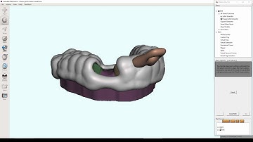 D3Lab x64  -  Custom Tray Fabrication and Undercut Blockout