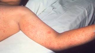 Measles Vaccine Policy Challenges for Southern Tier