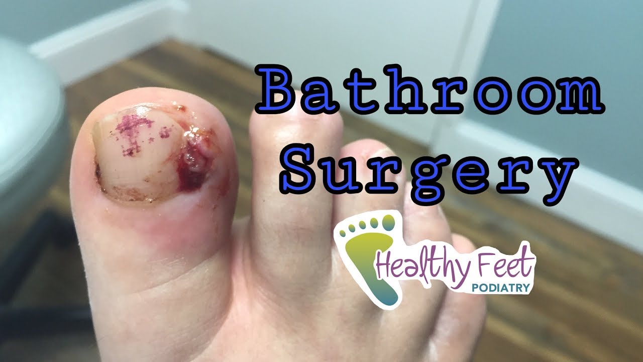 Fungal Nails Infection Free After 20 Years! Surgery and Laser