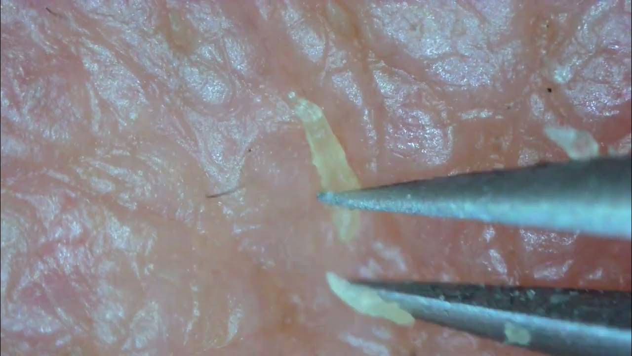 0228 keratin plug removal chin YouTube