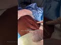 ANTES E DEPOIS DE UM ABDÔMEN APÓS GESTAÇÃO | Dr. Ícaro Samuel #abdominoplastia #gestação