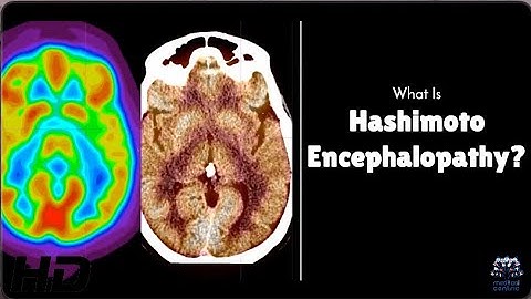 Hashimoto Encephalopathy: Is Your Brain at Risk?