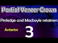 crown|partial veneer crown (pinledges and Macboyle retainers)3