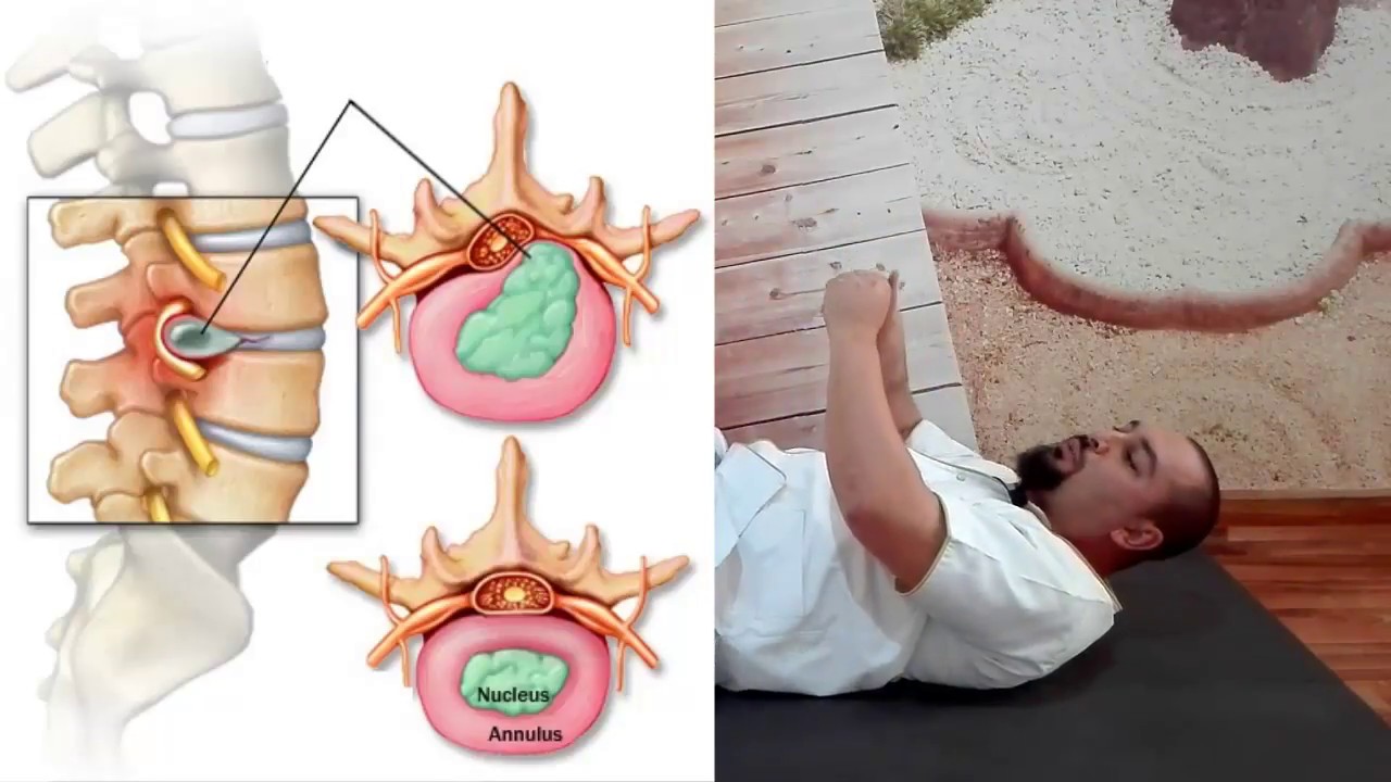 السياتيك الحلقة8: أنسب طريقة لنوم مريض السياتيك والحركات الممنوعة عليه