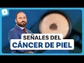 Cáncer de Piel: las señales que no puedes ignorar