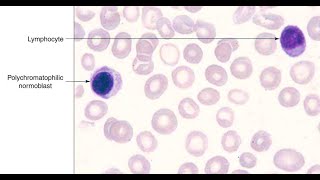 كرات الدم الحمراء تسبب ارتفاع فى كرات الدم البيضاء ( nucleated RBCs)WBCs And Normoblast Correction