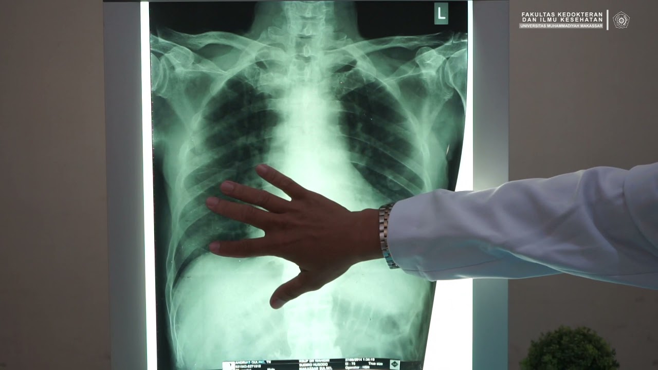 CSL II - Radiologi Respirasi