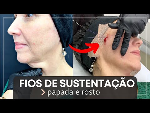 Vídeo: 3 maneiras de aplicar uma tração na pele