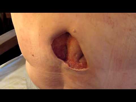 La crème et les comprimés du psoriasis