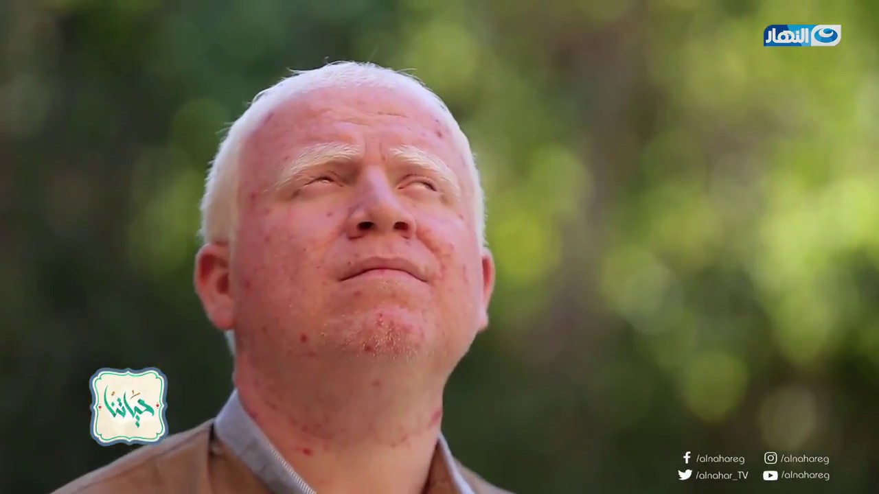 حياتنا - أحمد أسعد عدو الشمس.. مؤسس أول صفحة ألبينو في مصر يسرد معاناته في مصر بسبب لون بشرته