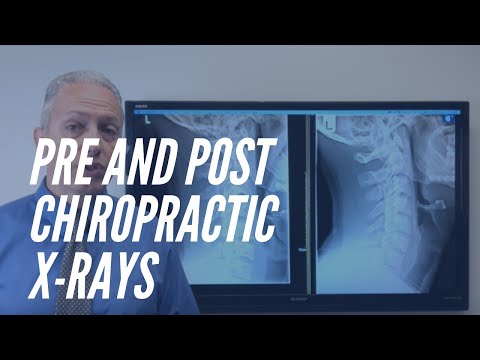 Video: Can chiros nyeem x rays?