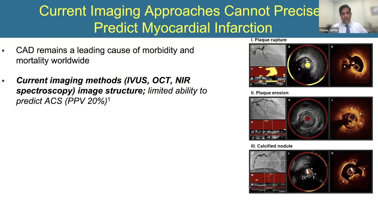 “Imaging Coronary Inflammation in the Cardiac Catheterization Laboratory: The Next Frontier”