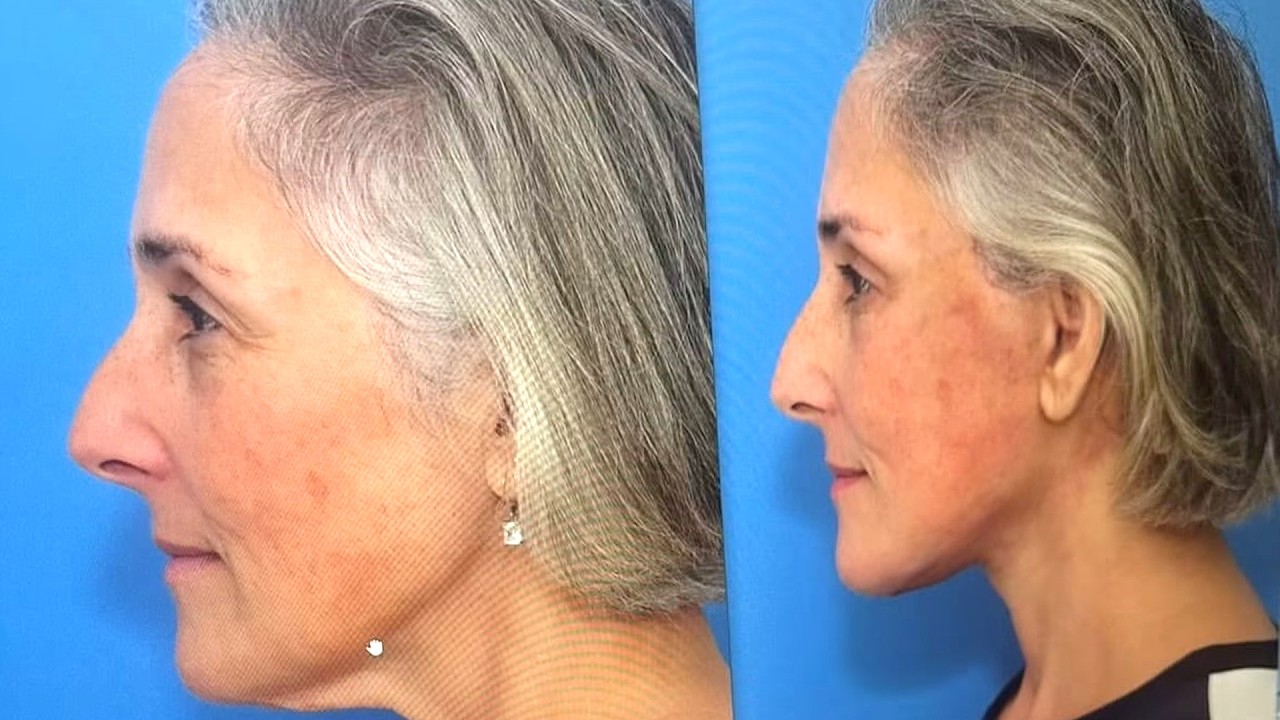 Ricki Lake Shares DRAMATIC Facelift Before and After