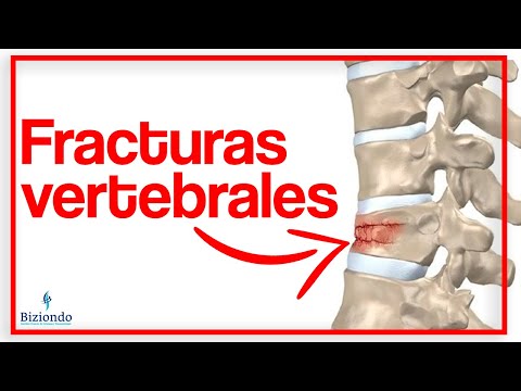 Video: ¿Curará una vértebra aplastada?