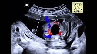 Cloacal Exstrophy Oeis Syndrome Fetal Ultrasound