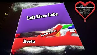 Celiac Artery Compression Syndrome Ultrasound