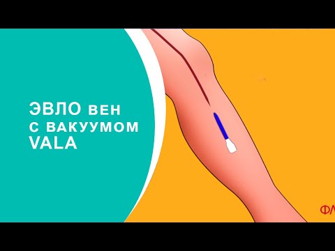 Лазерная облитерация вен с вакуумом VALA