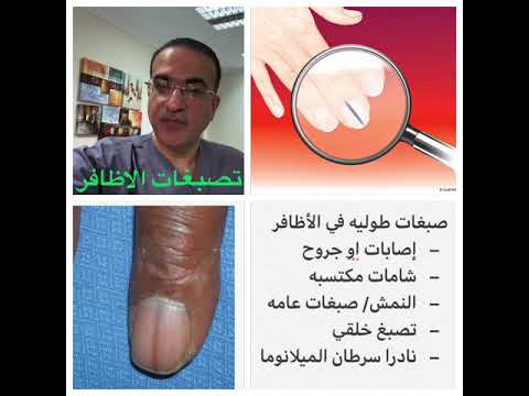 تصبغات طولية في الأظافر