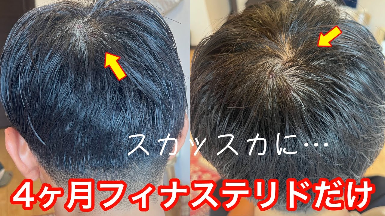 AGA治療】フィナステリド1mgだけで薄毛治療したらハゲが進行しました 