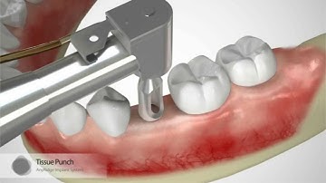patiënt informatie: Hoe wordt er geïmplanteerd