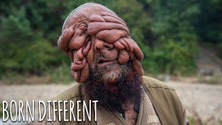 They Call Me 'The Man With No Face' | BORN DIFFERENT