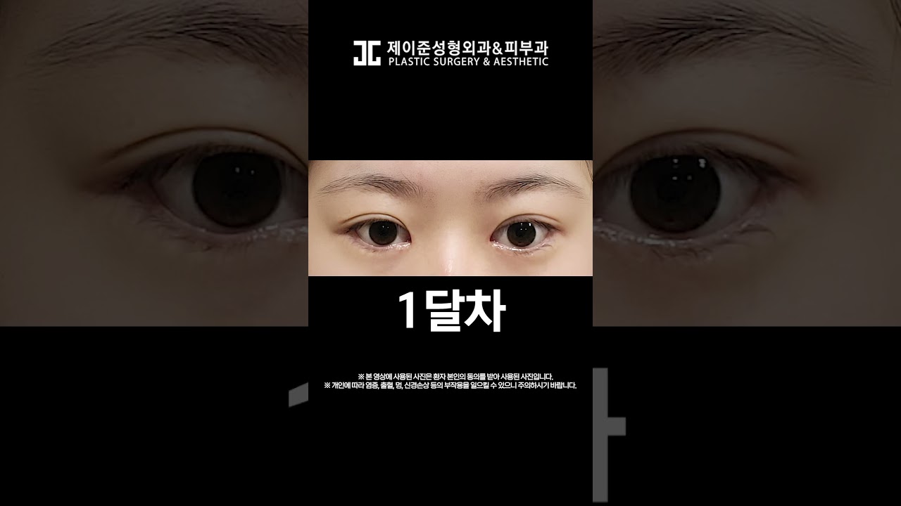 [Thẩm mỹ viện Jayjun] Nâng cơ mắt không phẫu thuật + mở góc mắt ✨So sánh trước sau✨ #shorts