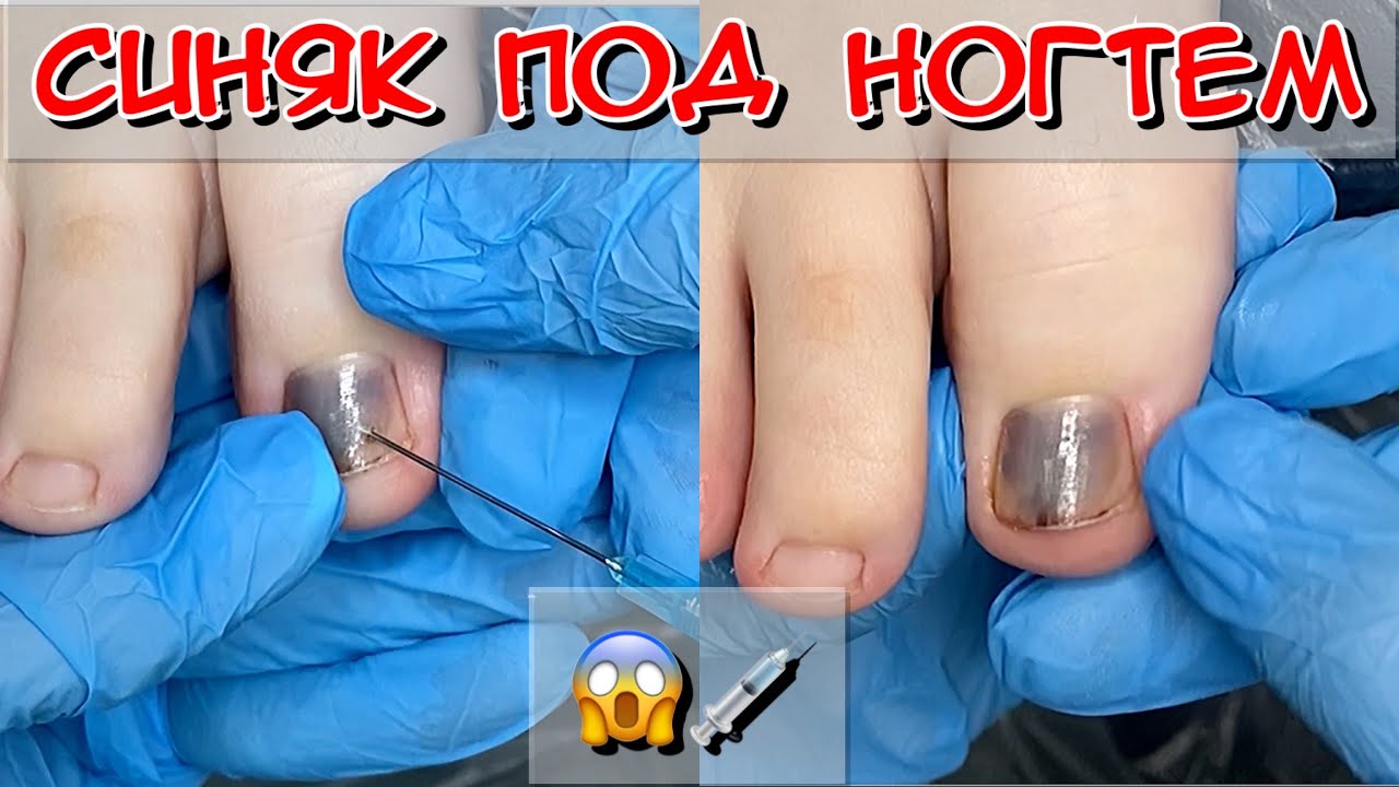 Игла под ноготь / Синяк под ногтем / Гематома под ногтем