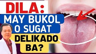 Dila May Bukol o Sugat: Delikado Ba? Alamin ang Senyales ng Oral Can-cer. - By Doc Willie Ong