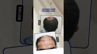 FUSE Hair – FUE Hair Transplant Result | dr.arvind poswal, best hair transplant in delhi