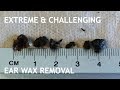 EXTREME & CHALLENGING EAR WAX REMOVAL - #446