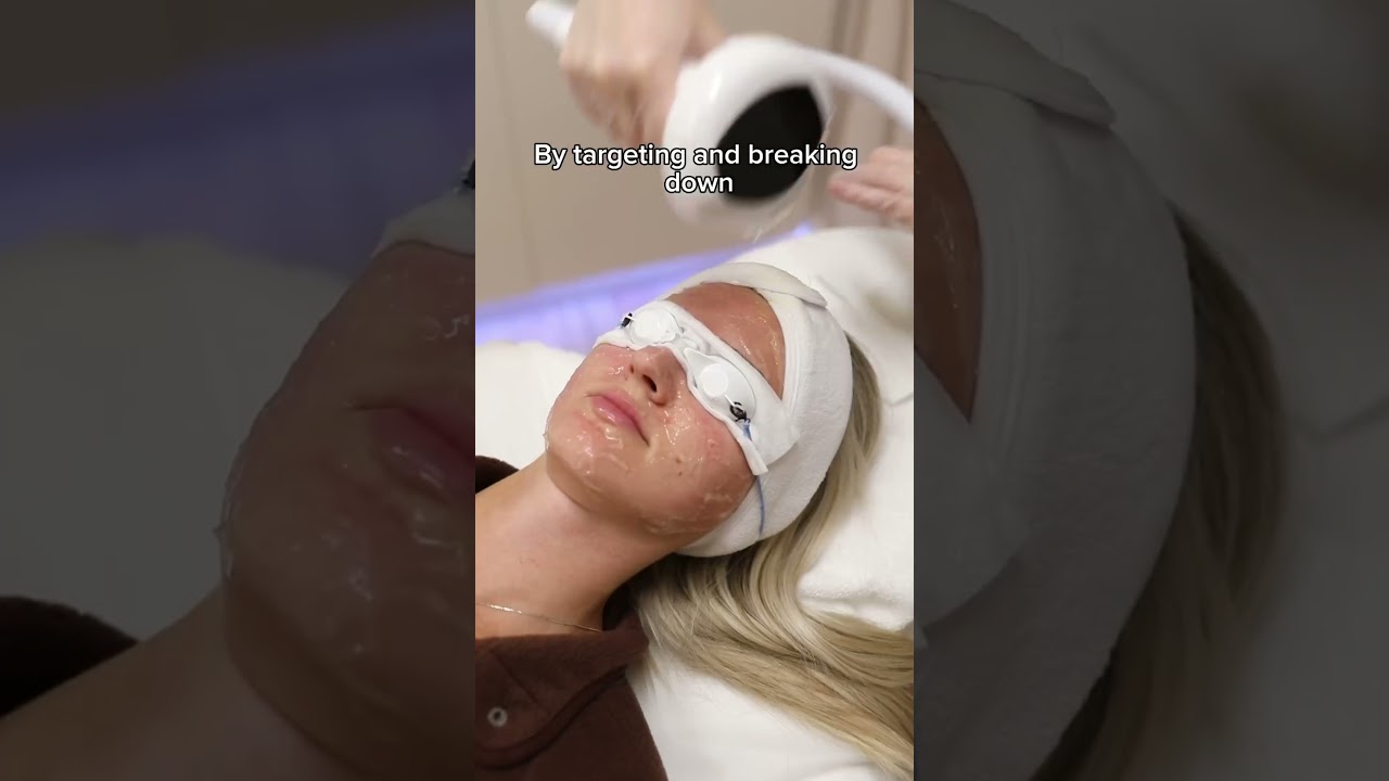 👀 What does a Lumecca IPL treatment look like?