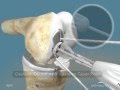 Unicap femoral animation