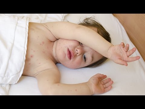 Кожный зуд у ребёнка - YouTube